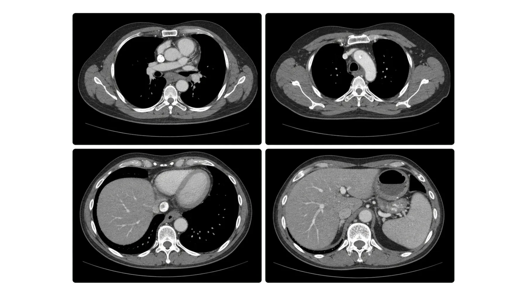 Axial CT / chest & upper abdomen