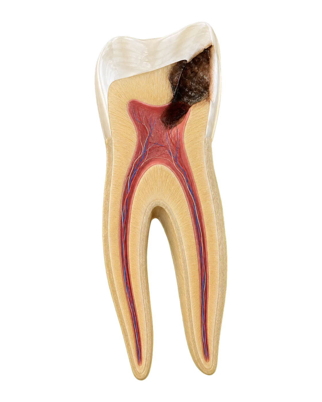 Deep caries reaching the pulp