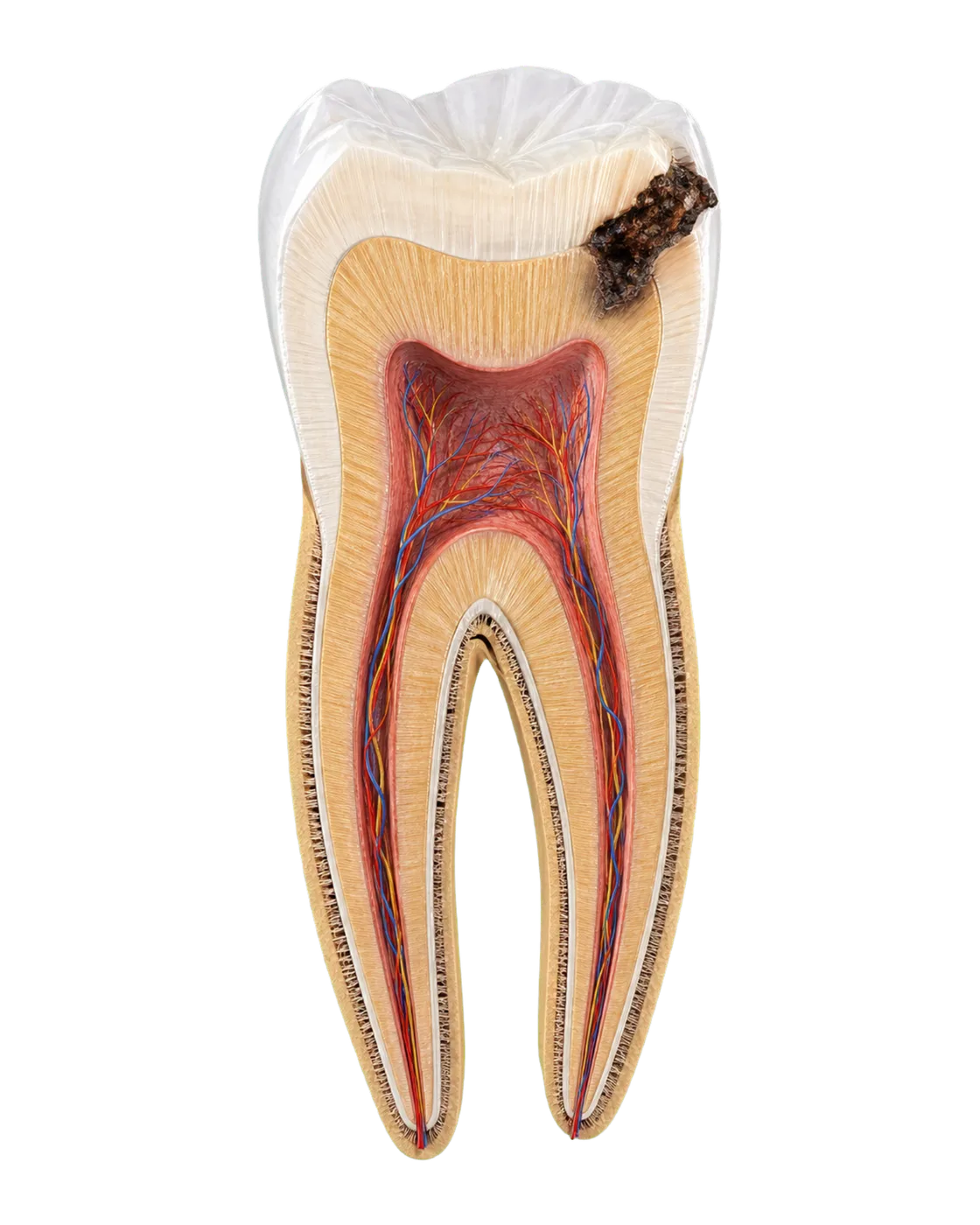 Molar with caries, in section